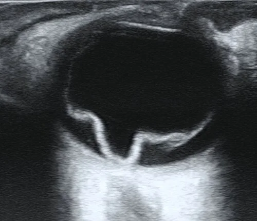 b scan us study, the diagnosis is hidden until you answer