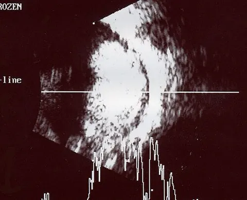 b scan us image, diagnosis hidden