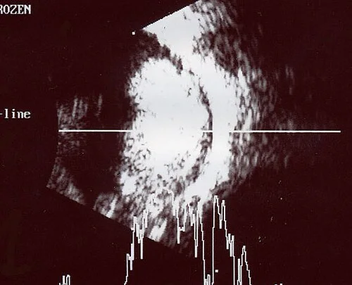 b scan us study, the diagnosis is hidden until you answer