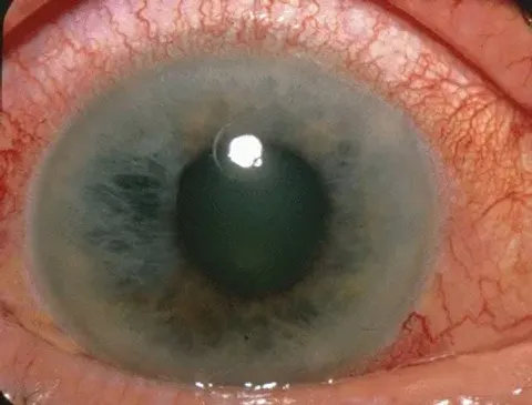 external close-up photograph of an eye, diagnosis hidden