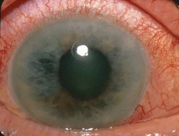 external close-up photograph of an eye, diagnosis hidden