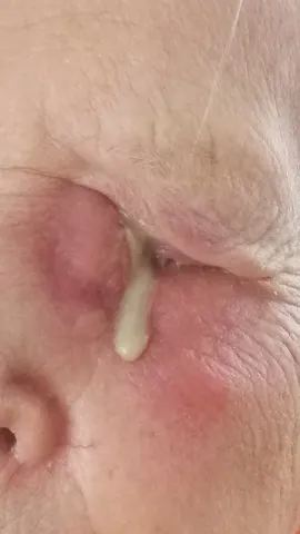 photograph of the inner corner of an eye and the side of the nose, diagnosis hidden