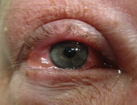 external close-up photograph of an eye, diagnosis hidden