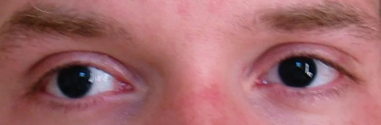 photograph of two eyes, diagnosis hidden