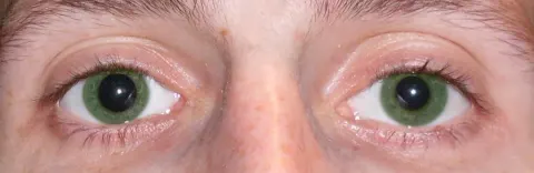 photograph of two eyes in room light, diagnosis hidden
