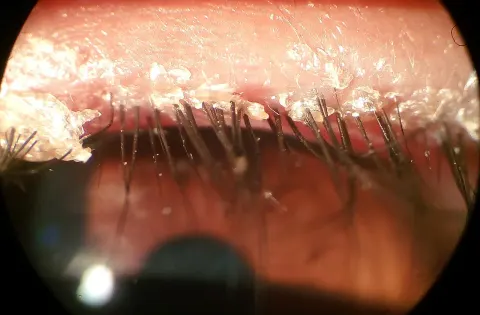 slit lamp close-up of an eyelid margin and lashes, diagnosis hidden