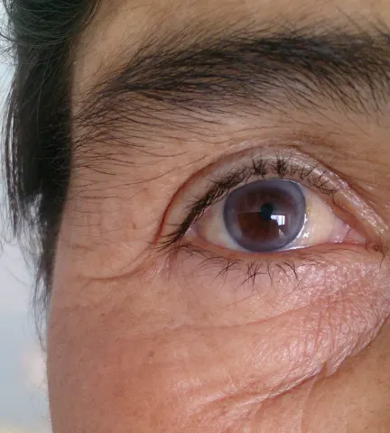 external close-up photograph of an eye, diagnosis hidden