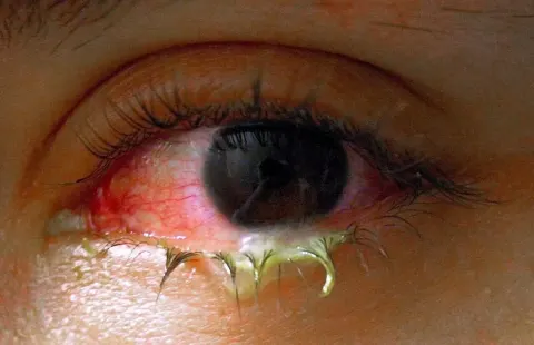 external close-up photograph of an eye, diagnosis hidden