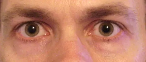 photograph of two eyes in room light, diagnosis hidden