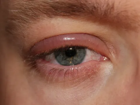 external close-up photograph of an eye and its lids, diagnosis hidden