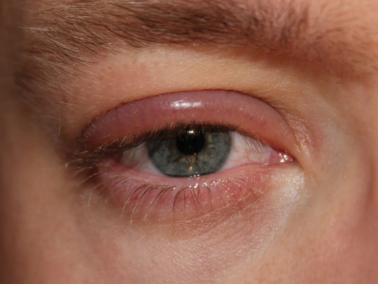 external close-up photograph of an eye and its lids, diagnosis hidden
