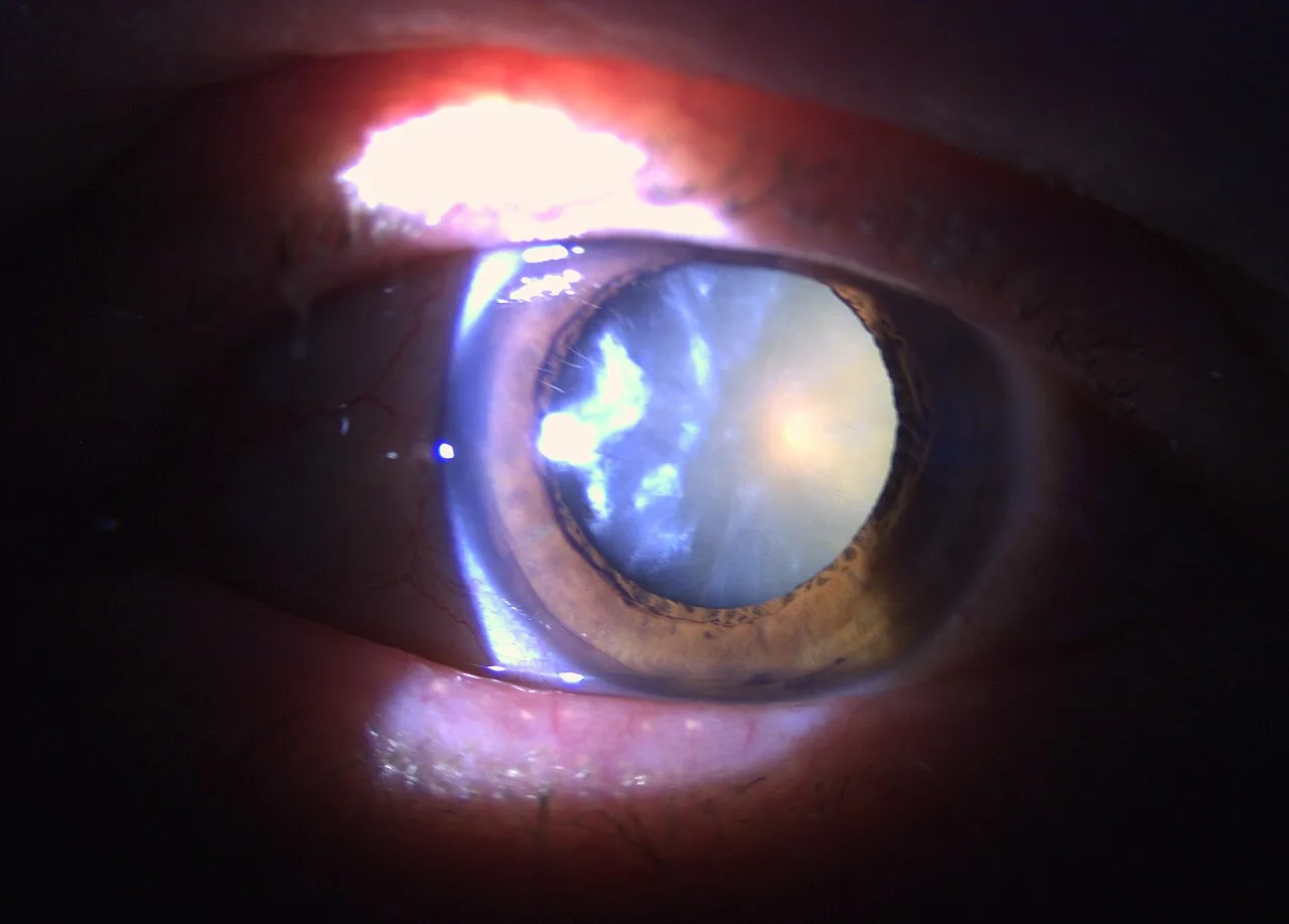external close-up photograph of an eye, diagnosis hidden