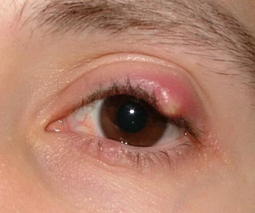 external photo study, the diagnosis is hidden until you answer