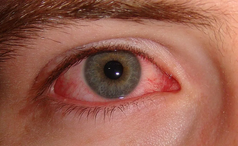 external photo study, the diagnosis is hidden until you answer