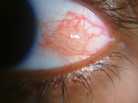 external close-up photograph of an eye, diagnosis hidden