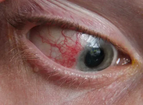 external close-up photograph of an eye, diagnosis hidden