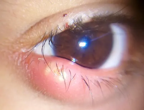 external close-up photograph of an eye and lower lid, diagnosis hidden