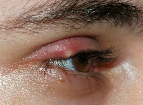 external photograph of an eye and its upper lid, diagnosis hidden