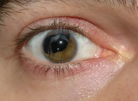 external close-up photograph of an eye, diagnosis hidden