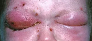 photograph of swollen, closed eyelids, diagnosis hidden