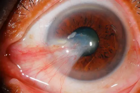 slit lamp photograph of the front of an eye, diagnosis hidden