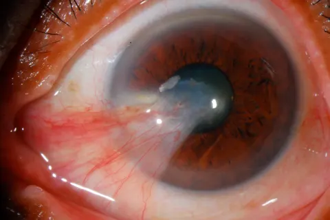 slit lamp photograph of the front of an eye, diagnosis hidden