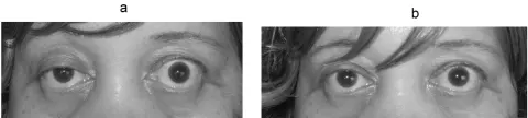 two photographs of the same pair of eyes, before and after a test
