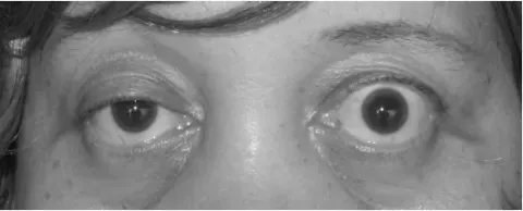 photograph of two eyes and lids, diagnosis hidden
