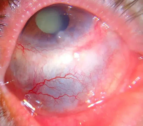 slit lamp photograph of the front of an eye, diagnosis hidden