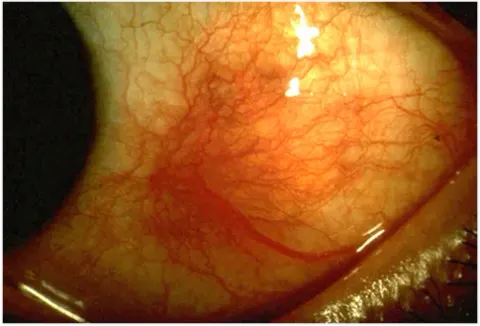 external close-up photograph of an eye, diagnosis hidden