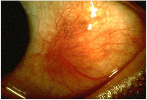 external close-up photograph of an eye, diagnosis hidden