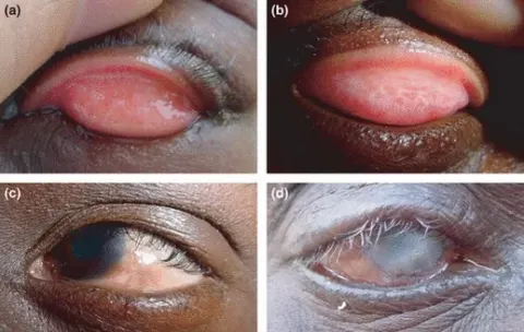 a four-panel figure of eyelids and eyes labelled a to d