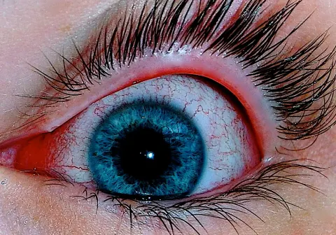 external close-up photograph of an eye, diagnosis hidden