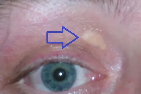 photograph of an eye and upper lid with an arrow from the source