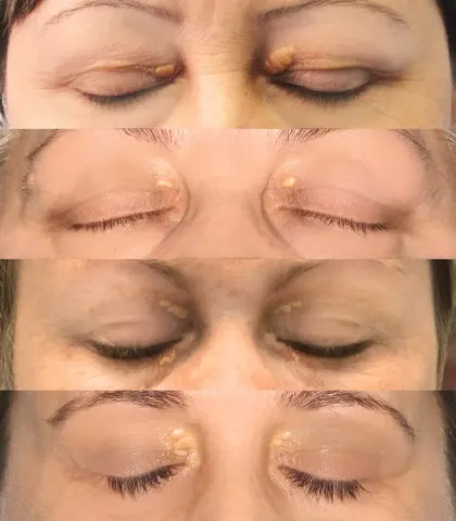 a series of photographs of closed eyelids from a surgeon's record