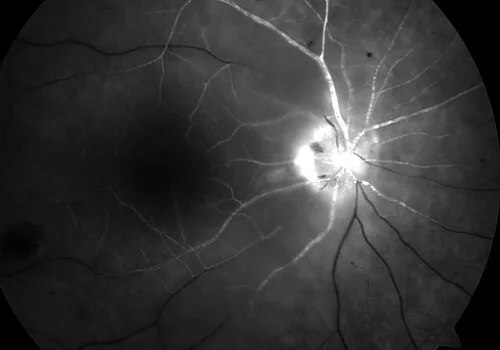 fluorescein angiography study, the diagnosis is hidden until you answer
