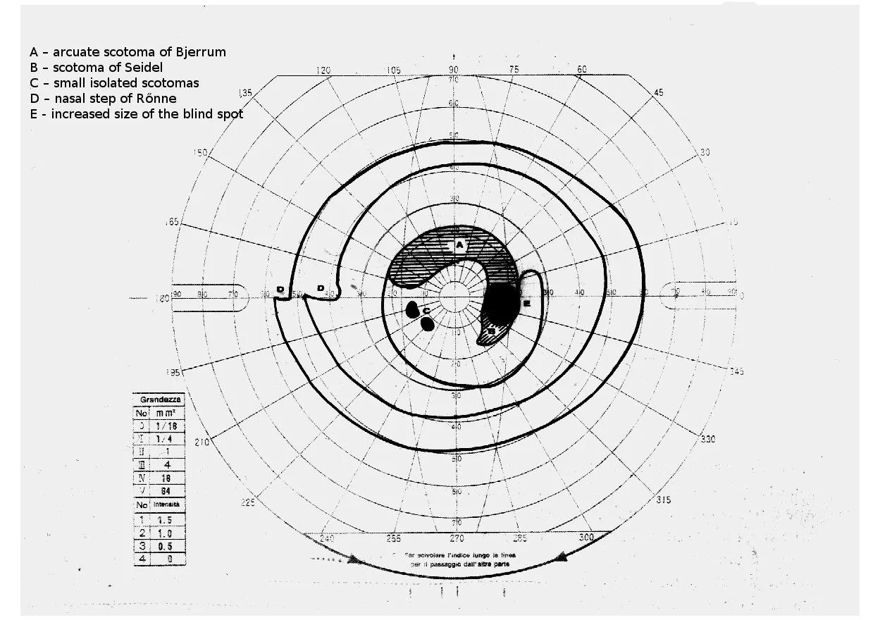 Glaucomatous visual field loss (annotated chart): An arcuate (Bjerrum) scotoma sweeping from the blind spot around fixation