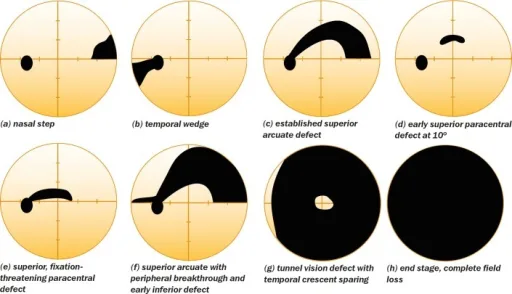 Glaucomatous visual field defects (schematic): Nasal step and temporal wedge: the earliest defects