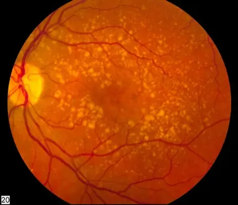color fundus image, diagnosis hidden
