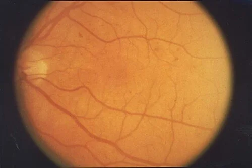 color fundus image, diagnosis hidden