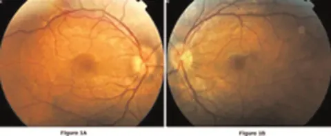 two colour fundus photographs, right and left eyes, diagnosis hidden