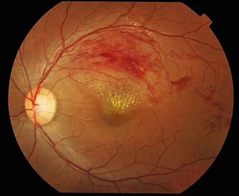 color fundus image, diagnosis hidden