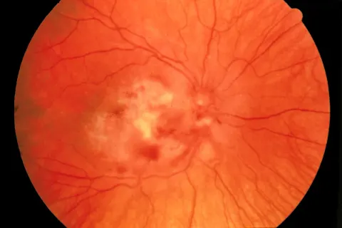 color fundus image, diagnosis hidden