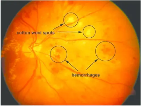 an annotated color fundus image with labelled circles and arrows