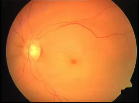 color fundus image, diagnosis hidden