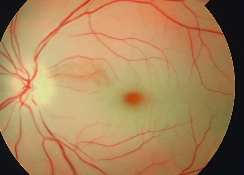 color fundus image, diagnosis hidden