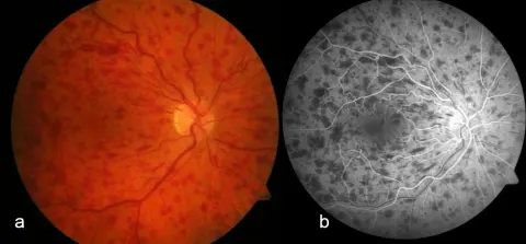 two-panel figure: a color fundus photograph and a fluorescein angiogram, diagnosis hidden