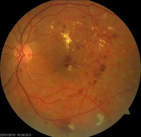 color fundus image, diagnosis hidden
