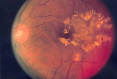 color fundus image, diagnosis hidden