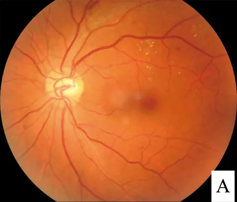 color fundus image, diagnosis hidden